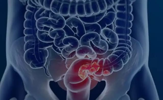 SUS adota novo exame para detectar câncer de intestino antes dos sintomas
