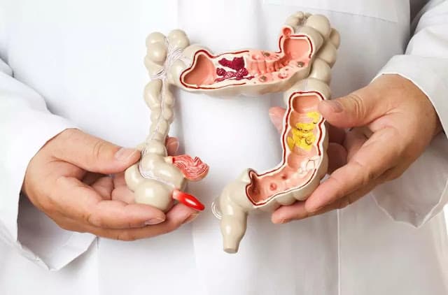 Cirurgias de câncer de intestino têm alta de 74%