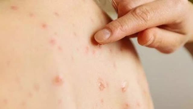 Brasil está em alerta máximo devido ao aumento de casos de sarampo nas Américas