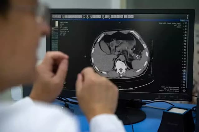 Inteligência artificial americana consegue detectar câncer de pâncreas anos antes de a doença aparecer