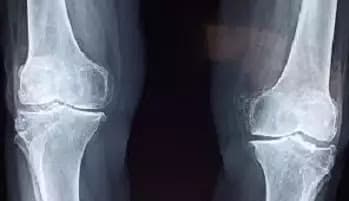 Osteopenia: por que essa condição que enfraquece os ossos costuma ser descoberta só depois de uma fratura